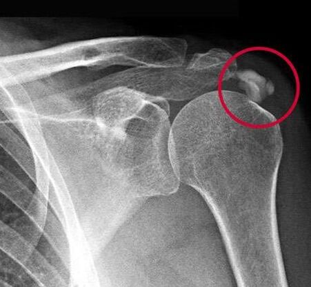 X-rays show calcium deposits in the joints