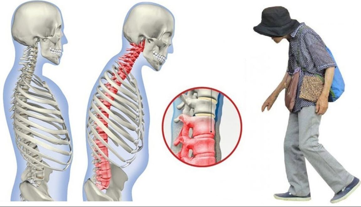 Back pain caused by ankylosing spondylitis