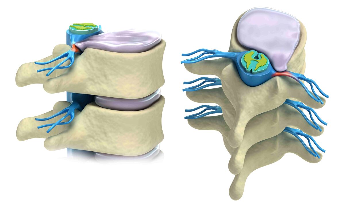 damaged intervertebral discs