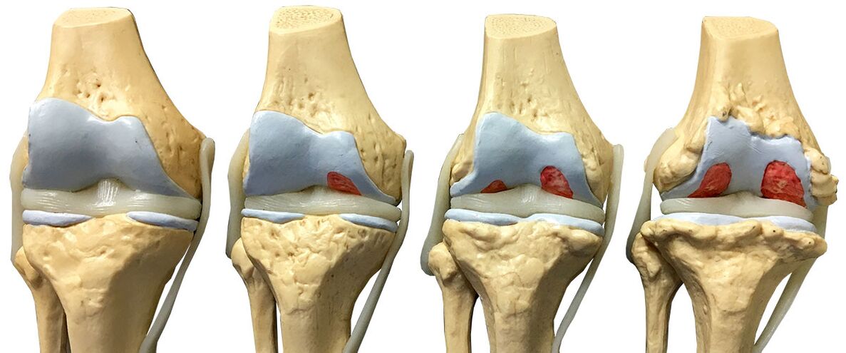 Stages of knee joints