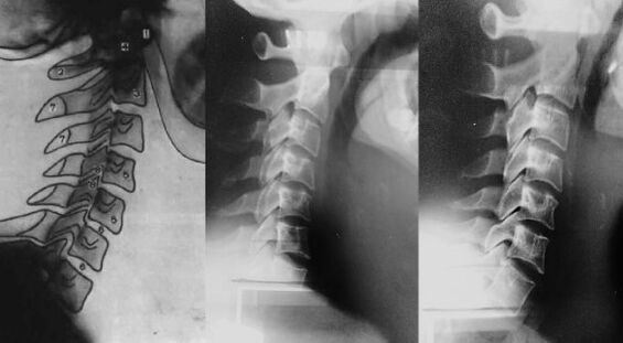 The displacement of the neck in the first cervical vertebra
