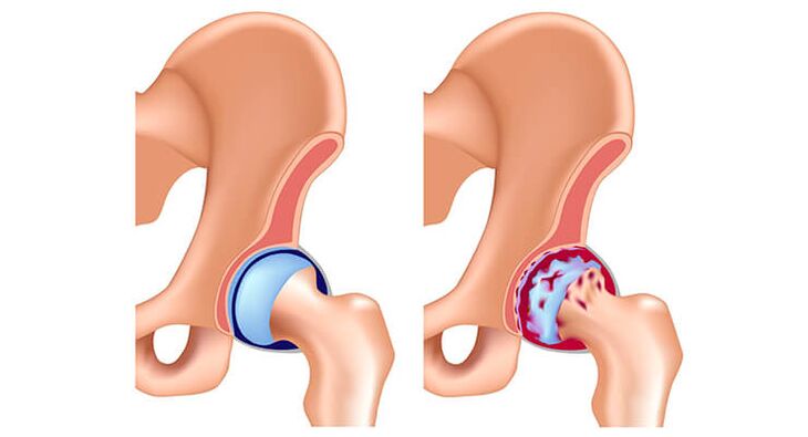 Hip arthritis