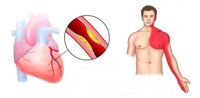 Heart syndrome